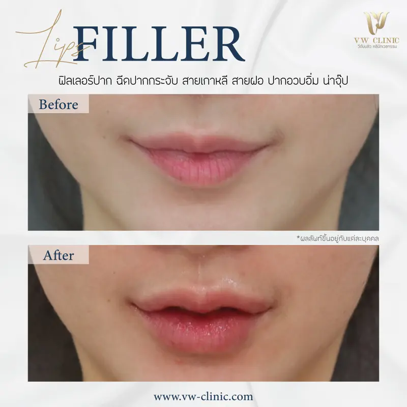 Filler ปาก