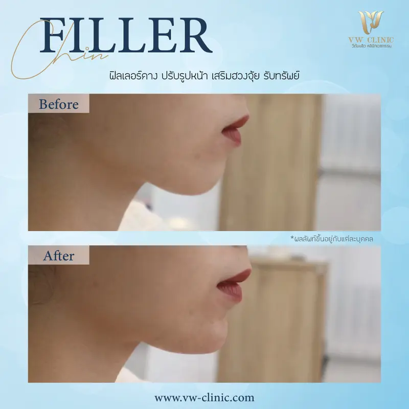 Filler คาง