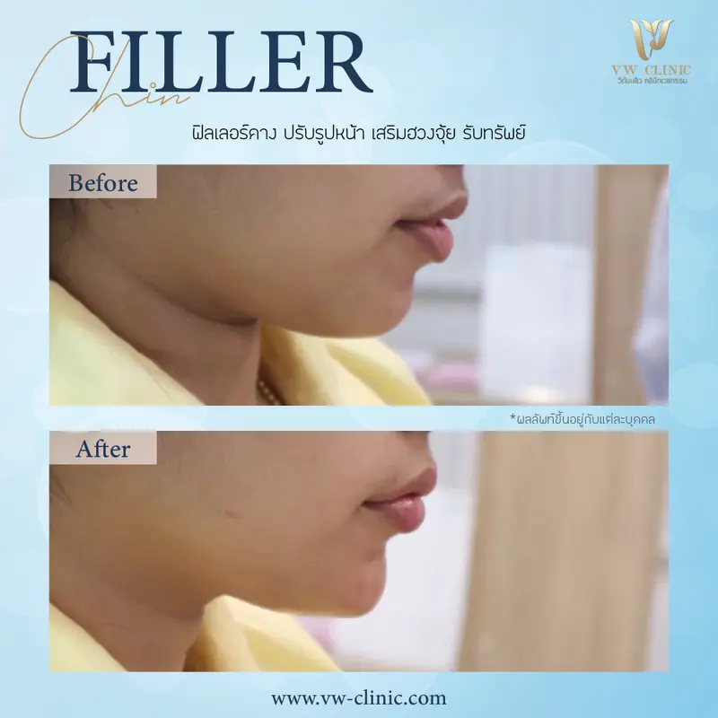 Filler คาง