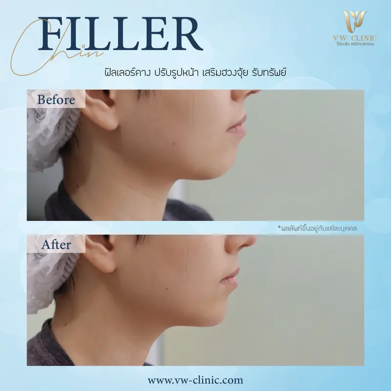 Filler คาง
