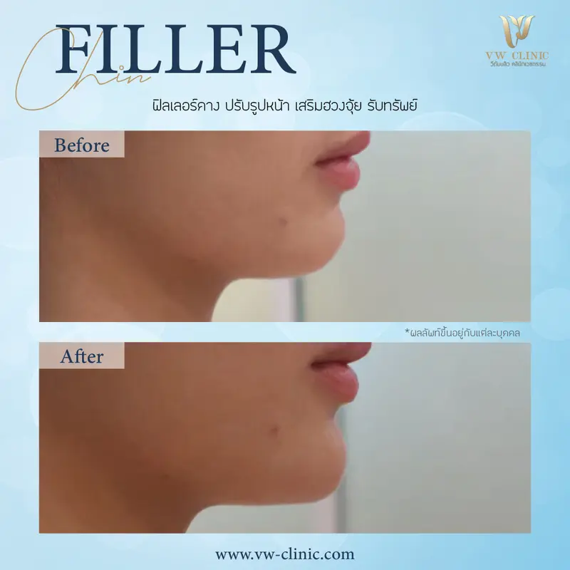 Filler คาง