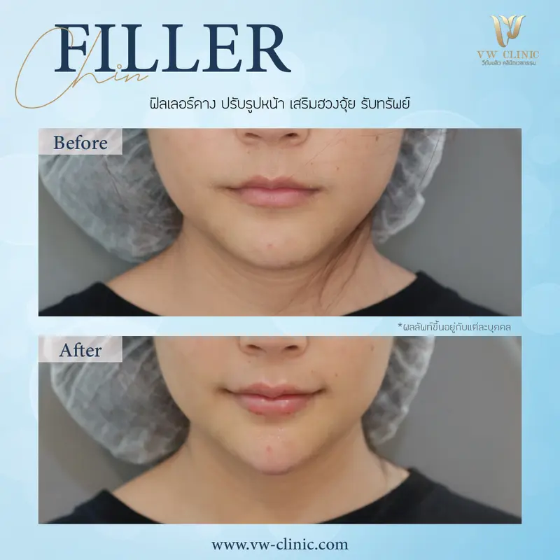 Filler คาง