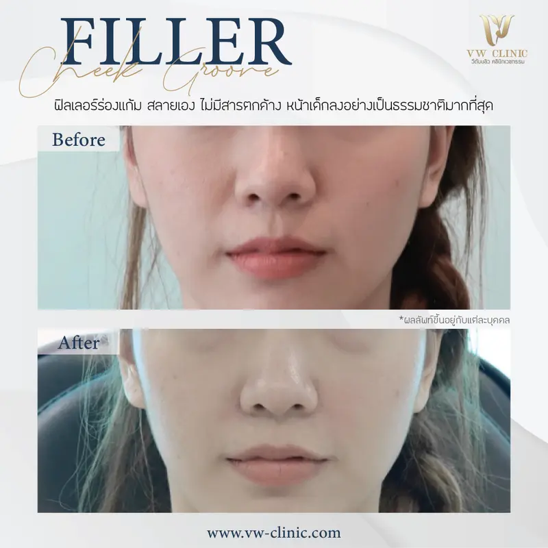 Filler ร่องแก้ม