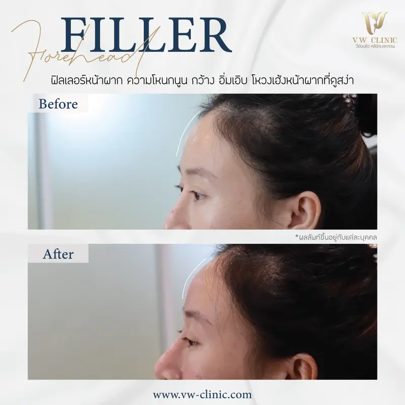 Filler หน้าผาก