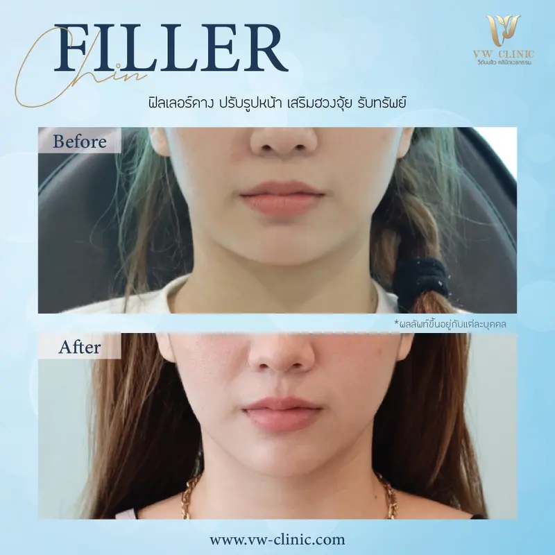 Filler คาง
