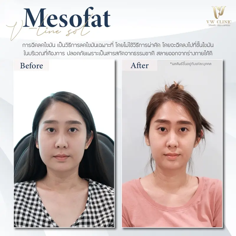 Fat แก้มเหนียง