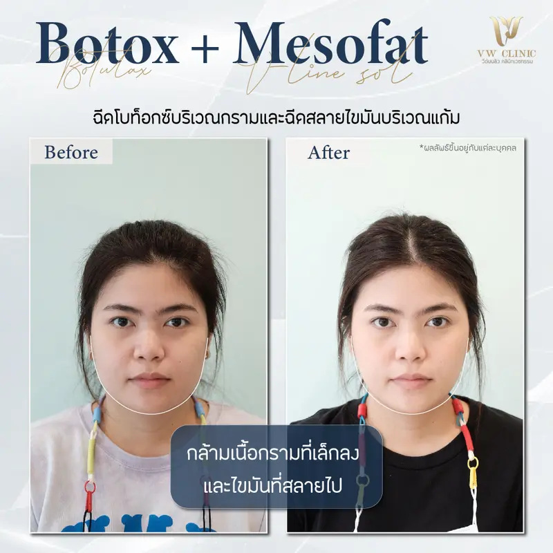 Botox กราม