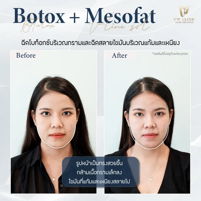 ฺBotox กราม