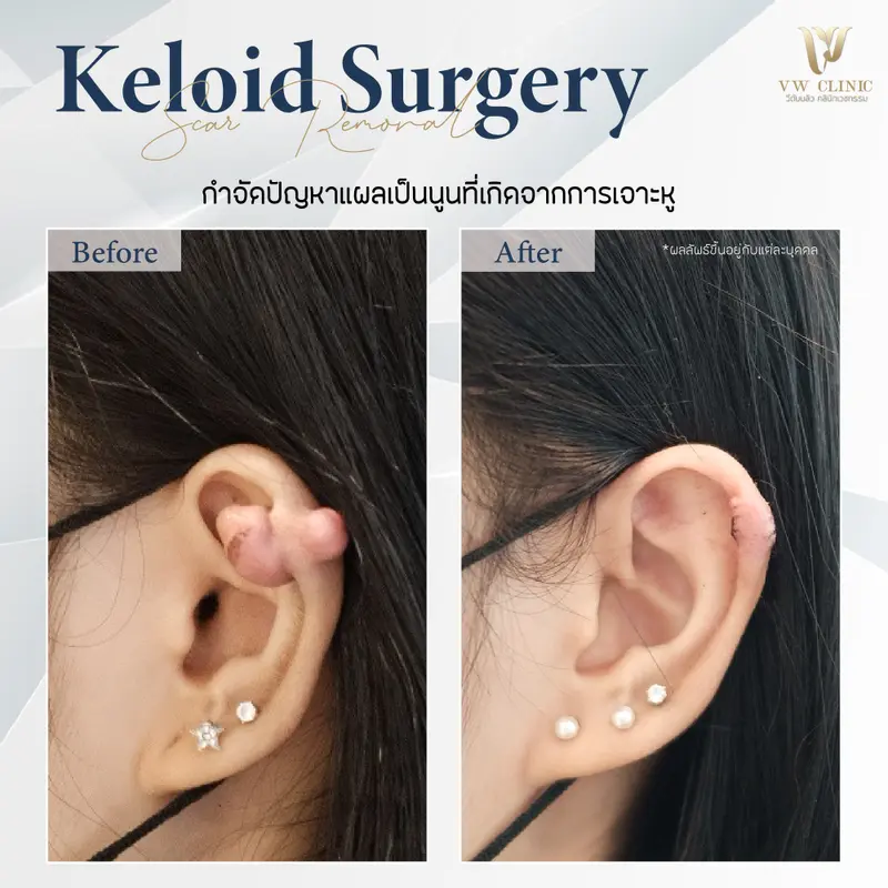 ผ่าตัดคีลอยด์หู