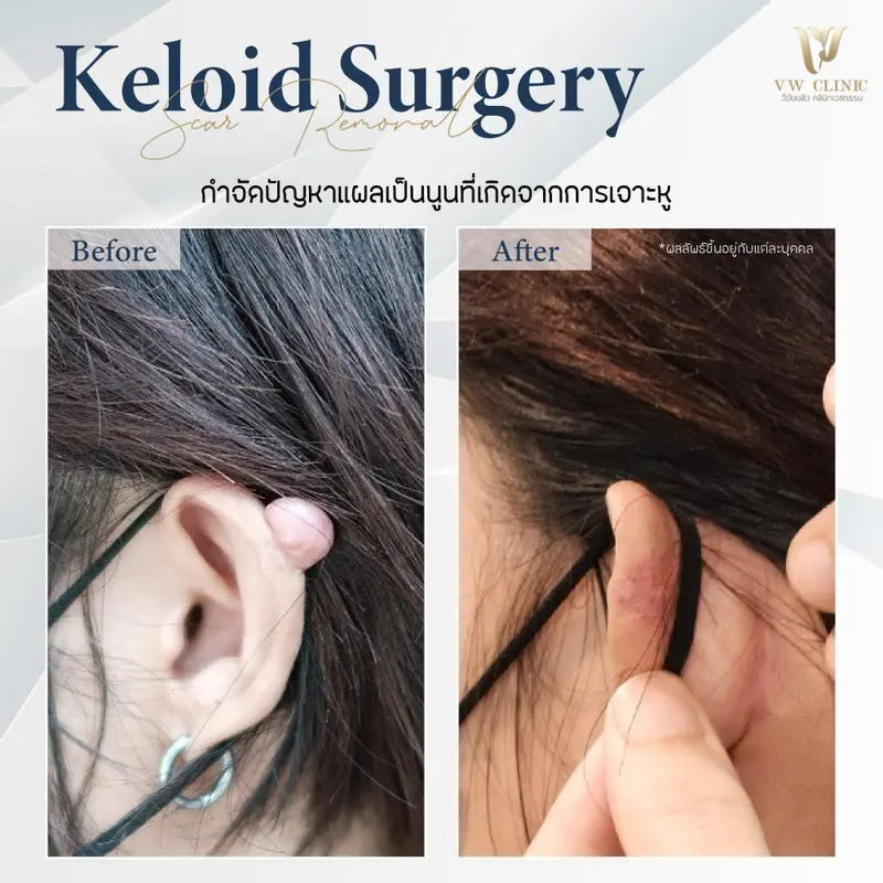 ผ่าตัดคีลอยด์หู