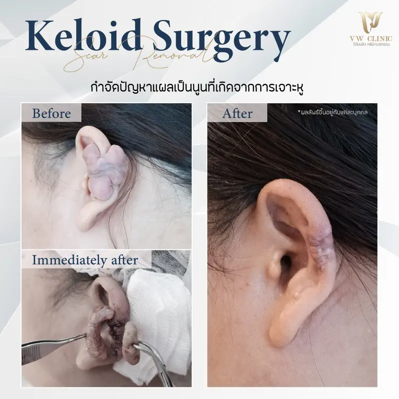 ผ่าตัดคีลอยด์หู