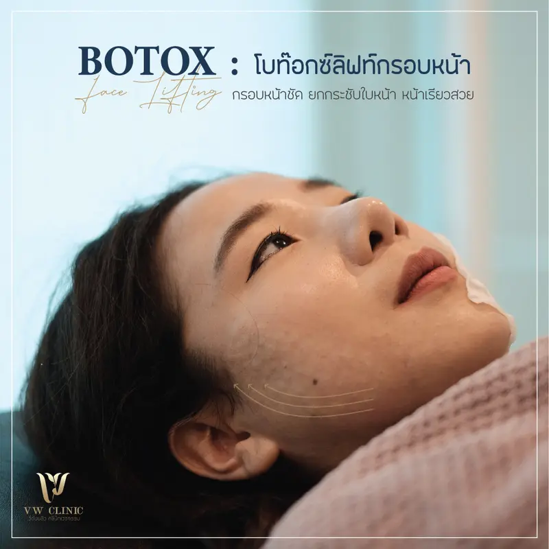 Botox lift กรอบหน้า