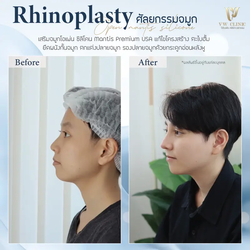 เสริมจมูก Open