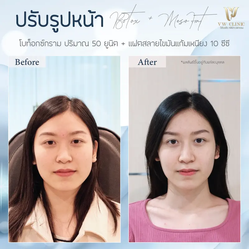 Botox กราม + Fat 10 cc แก้มเหนียง