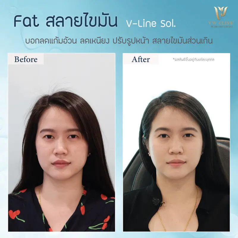 Fat 10 cc แก้ม