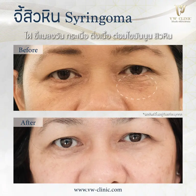 จี้สิวหิน 