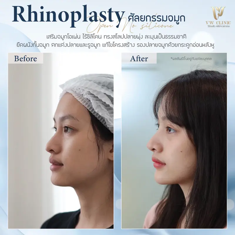 เสริมจมูกไร้ซิลิโคน