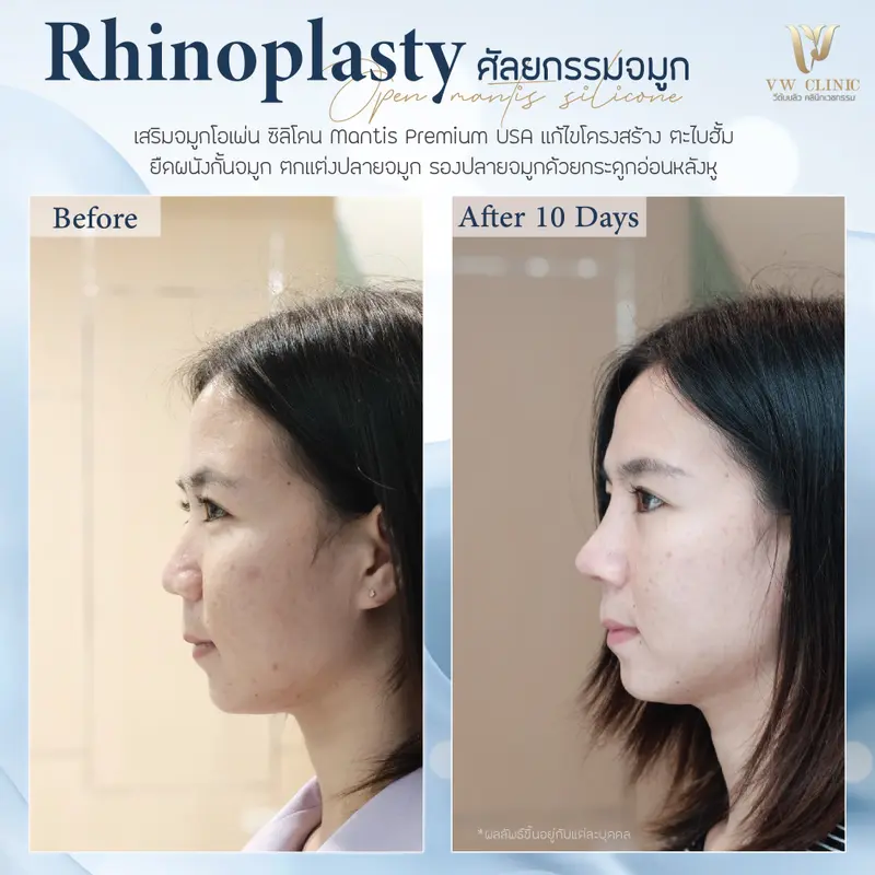 เสริมจมูก 