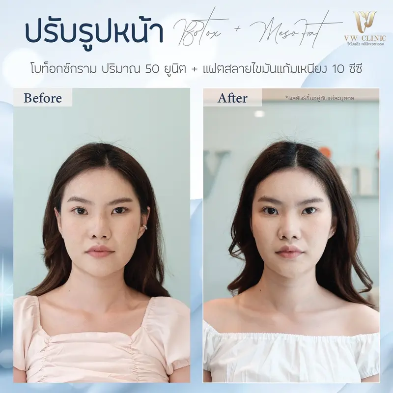 Botox กราม + Fat 10 cc แก้มเหนียง