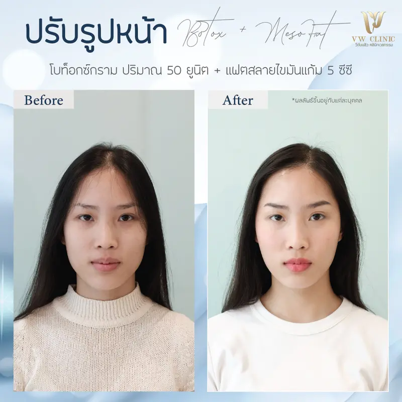 Botox กราม + Fat 5cc แก้ม