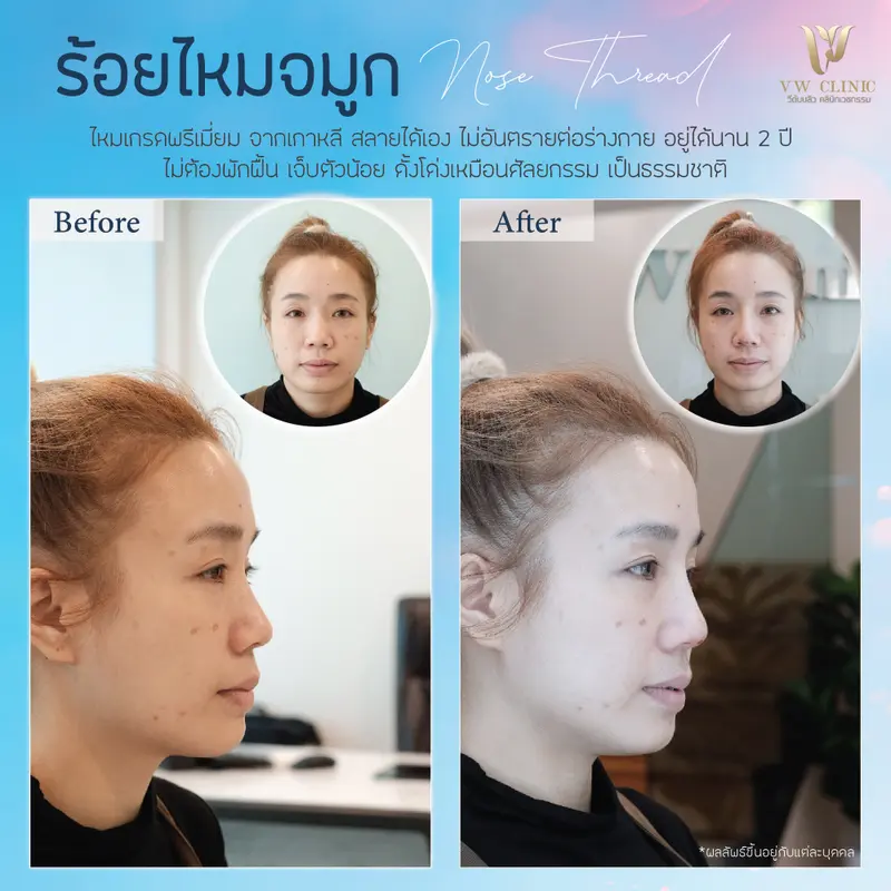 ร้อยไหมจมูก