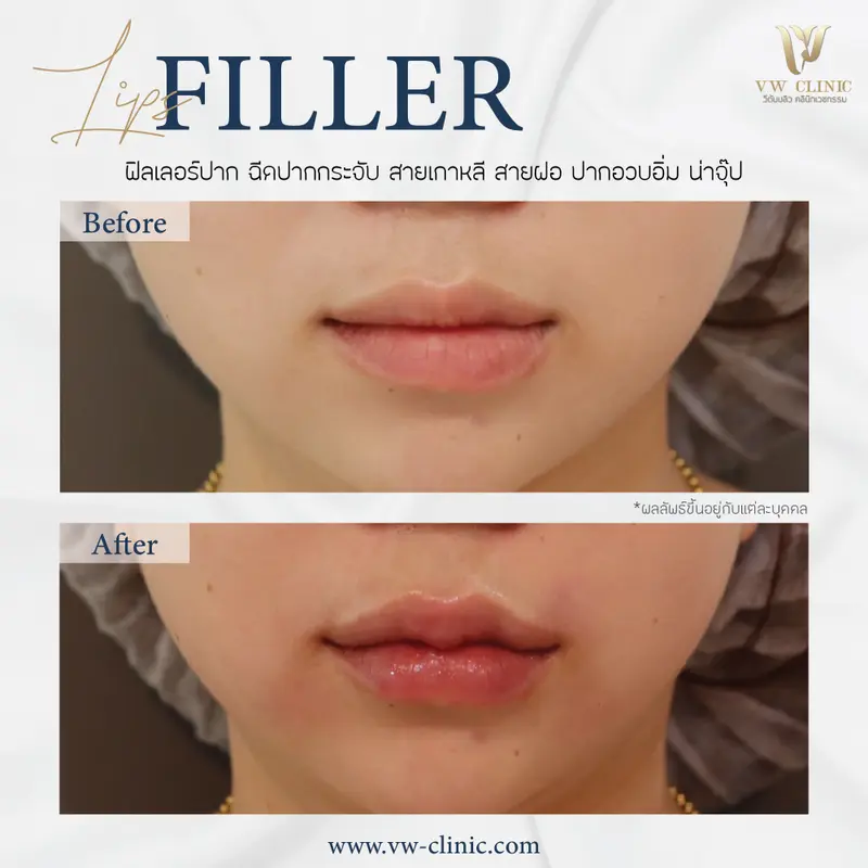 Filler ปาก