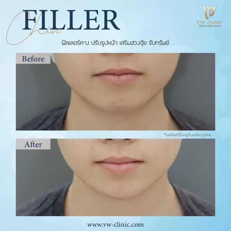 Filler คาง
