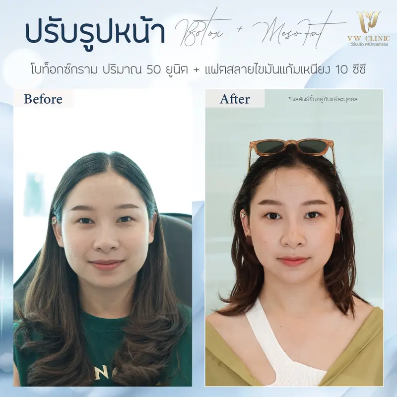 Botox กราม + Fat 10 cc แก้มเหนียง