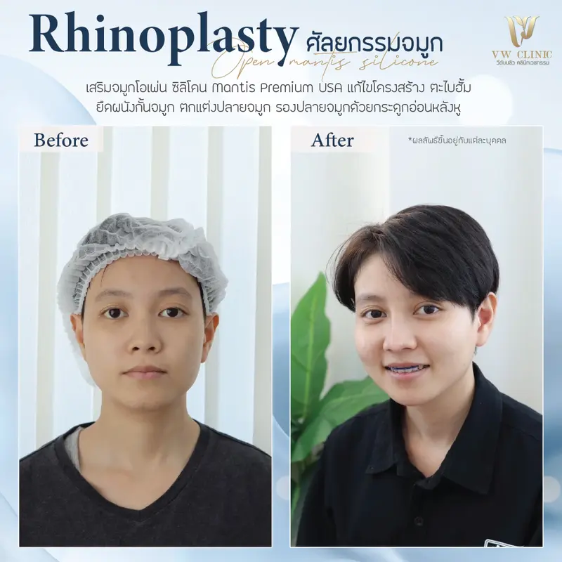 เสริมจมูก