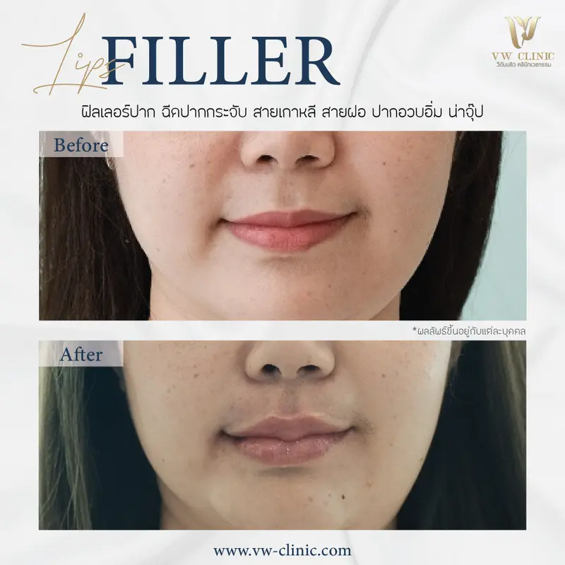 Filler ปาก