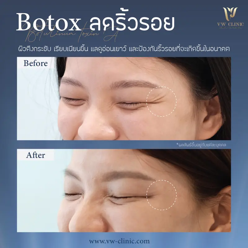Botox หางตา