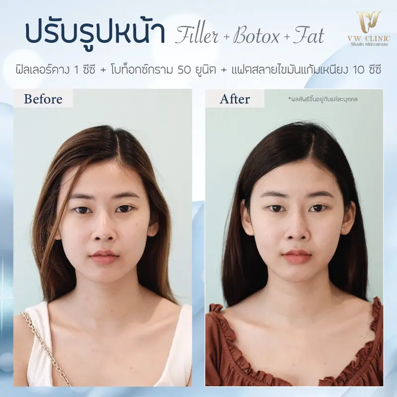 Filler คาง + Botox กราม + Fat แก้มเหนียง