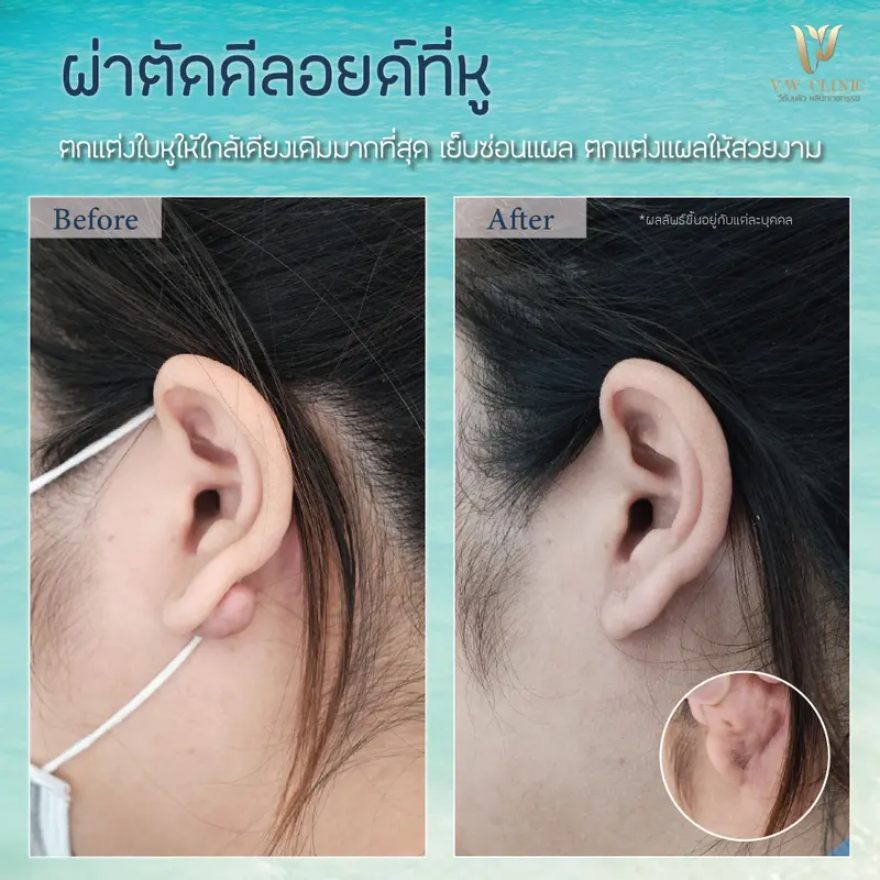 ผ่าตัดคีลอยด์หู