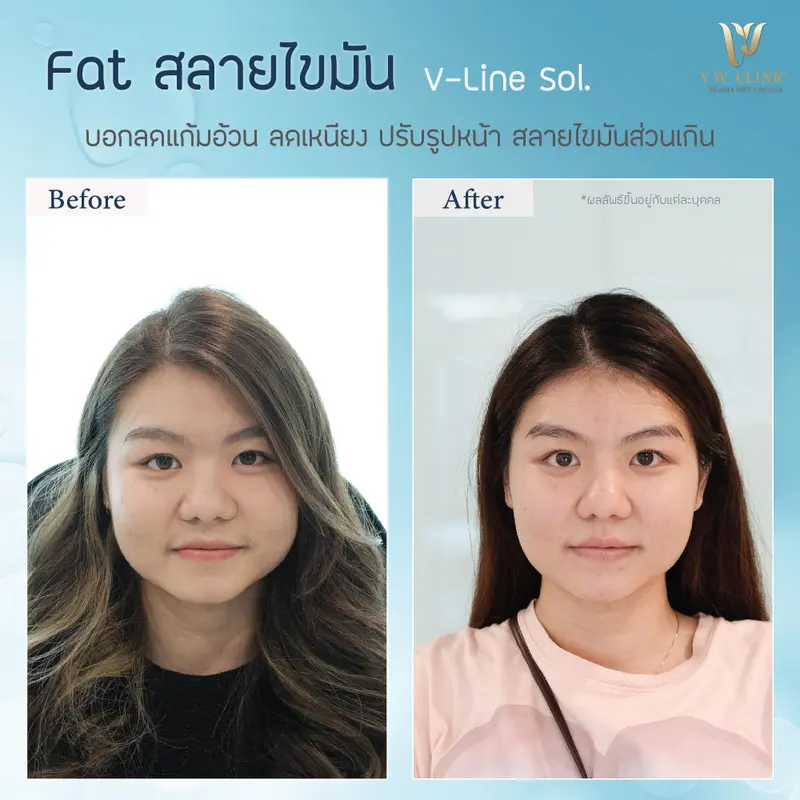Fat แก้ม