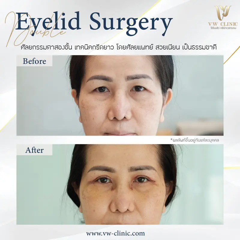 ตาสองชั้น 7 วัน