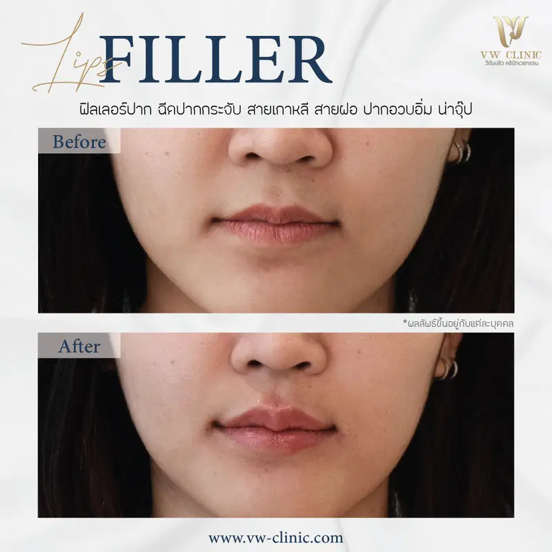 Filler ปากกระจับ