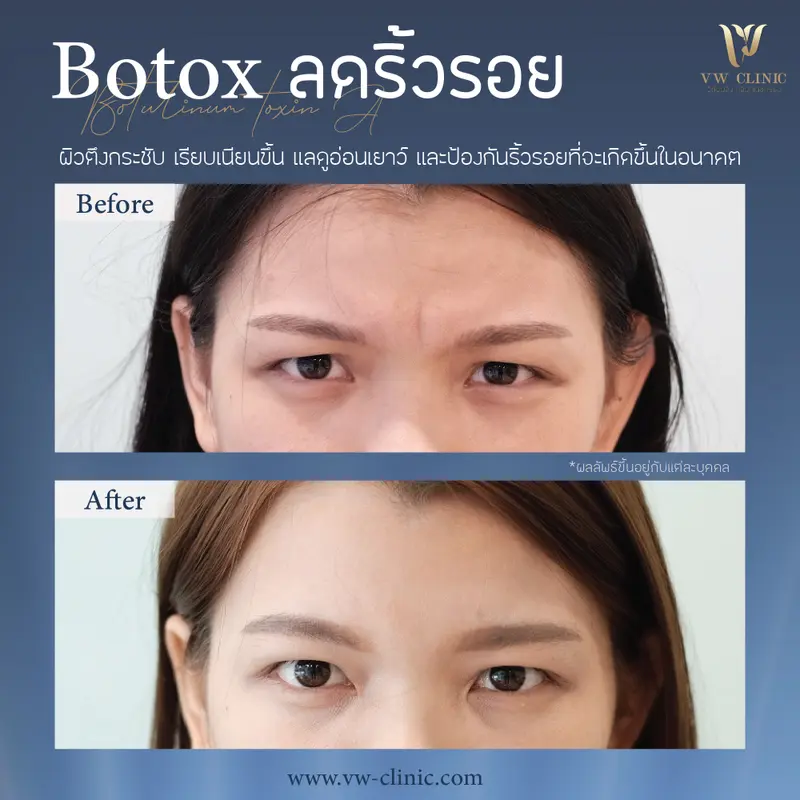 Botox หัวคิ้ว
