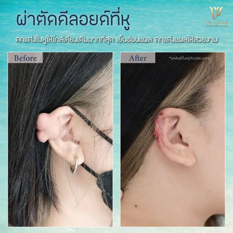 ผ่าตัดคีลอยด์หู