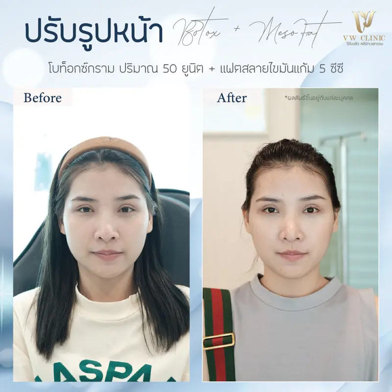 Botox กราม