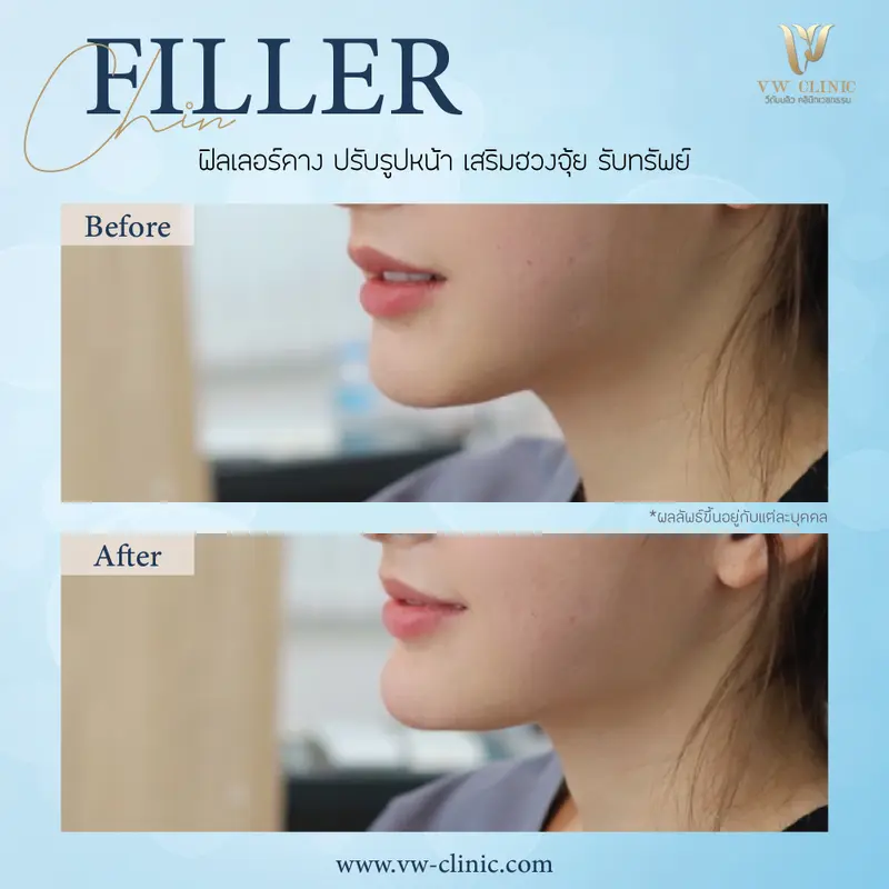 Filler คาง