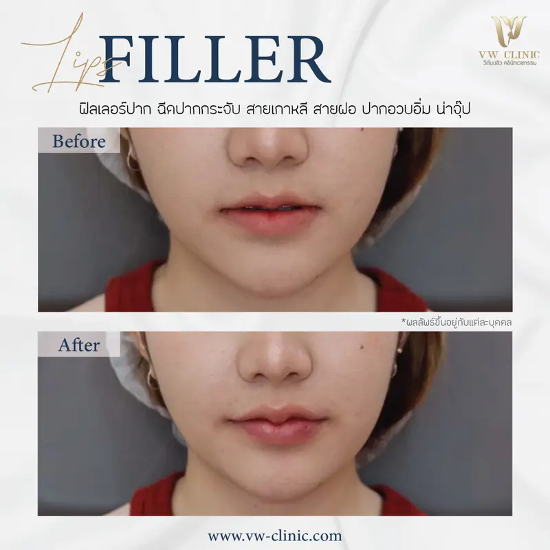 Filler ปาก