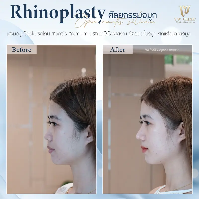 เสริมจมูก Open