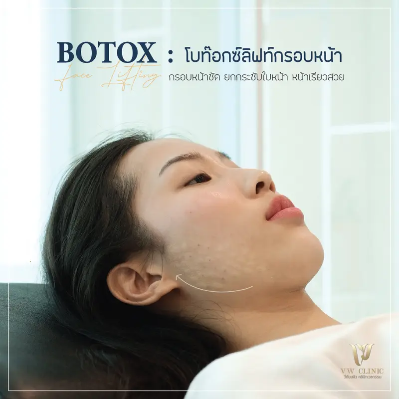 Botox lift กรอบหน้า