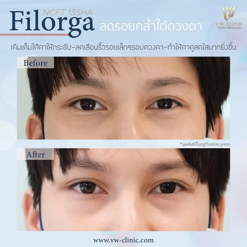 Filorga ลดรอยคล้ำใต้ตา