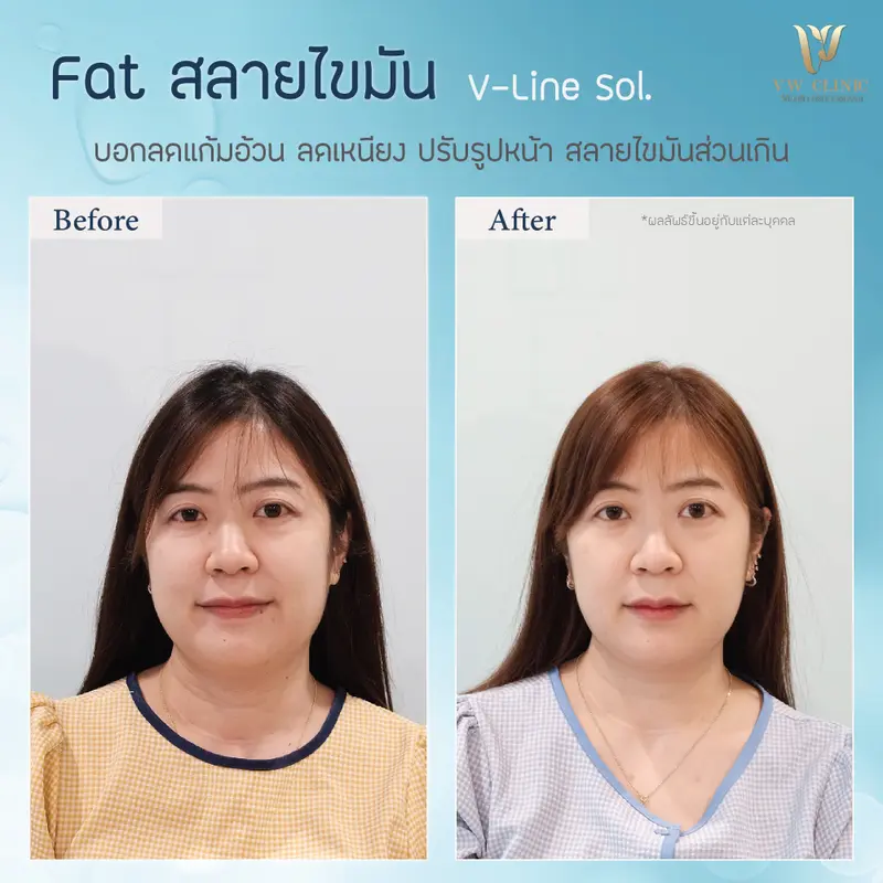 Fat แก้มเหนียง