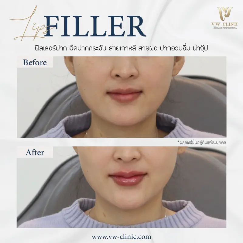 Filler ปาก