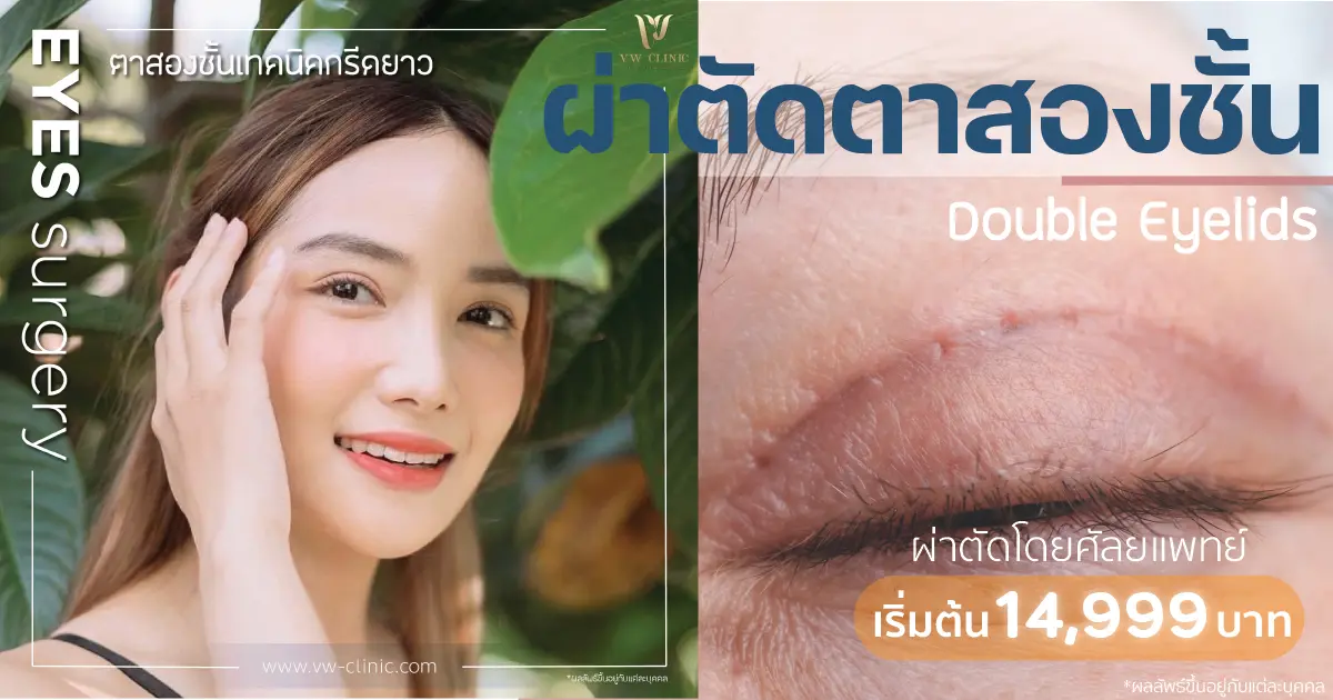 ตาสองชั้น สไตล์เกาหลี ผ่าตัดโดยศัลยแพทย์ 