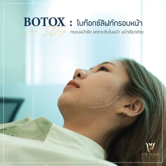 Botox lift กรอบหน้า