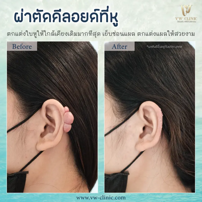 ผ่าตัดคีลอยด์หู