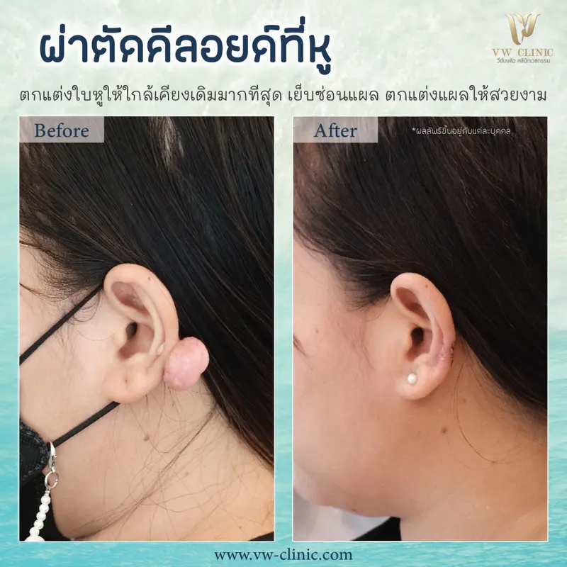 ผ่าตัดคีลอยด์หู